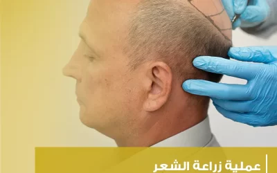 استعيد ثقتك وجمال شعرك مع عملية زراعة الشعر