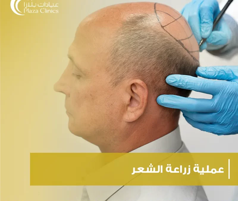 عملية زراعة الشعر