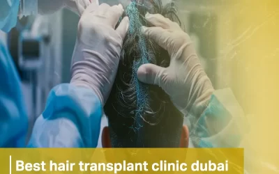 best hair transplant clinic dubai