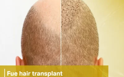 fue hair transplant