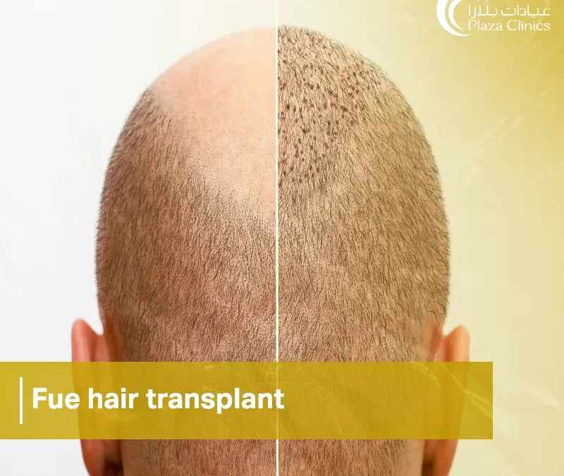 fue hair transplant