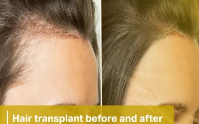 hair transplant before and after