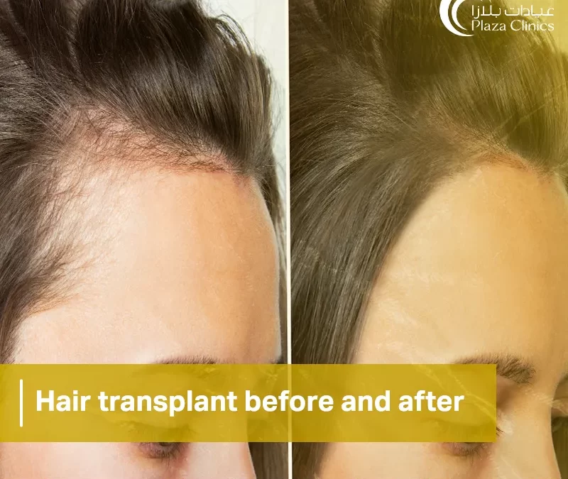 hair transplant before and after