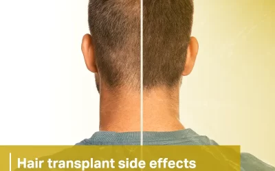 hair transplant side effects