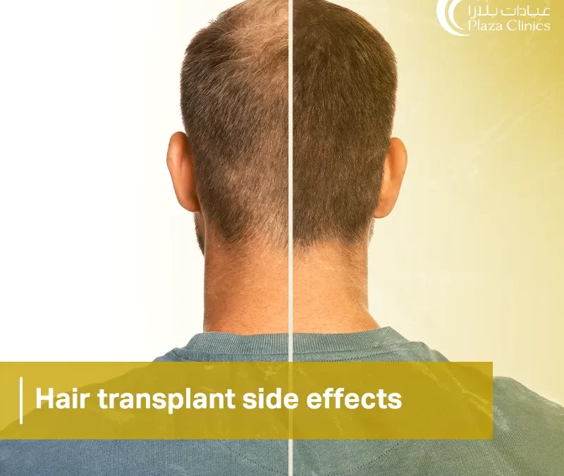 hair transplant side effects