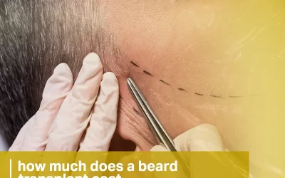 how much does a beard transplant cost?