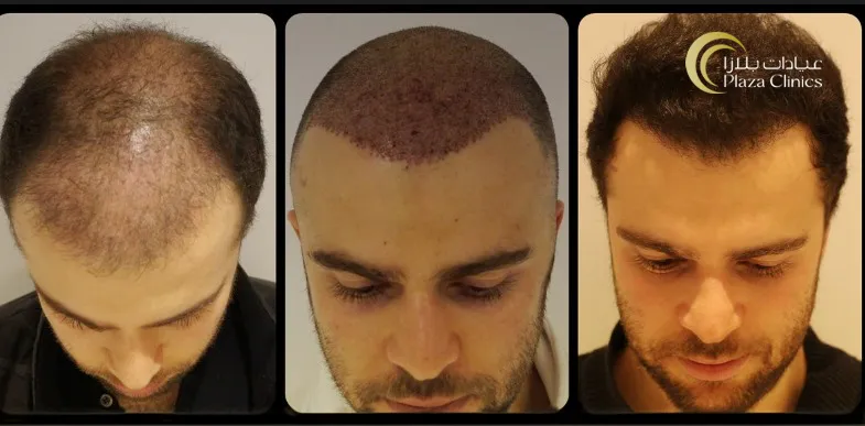 hair transplant before and after